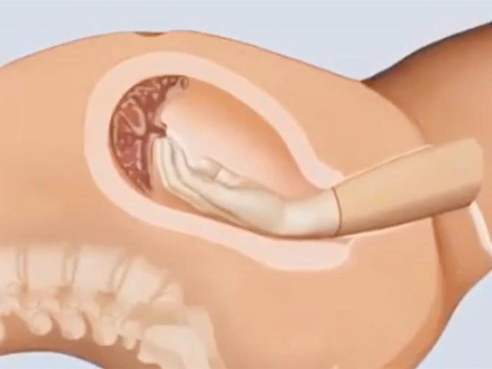 分娩产程的三大阶段,分娩时的产道