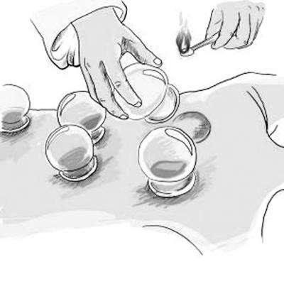 拔罐的好处那么多还要注意哪些