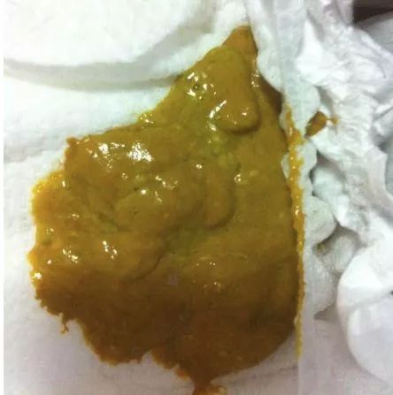 婴儿拉绿便的几种形状,宝宝拉绿便怎么鉴别