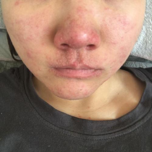 月经推迟体毛多是怎么回事,姨妈正常但是体毛多是什么原因