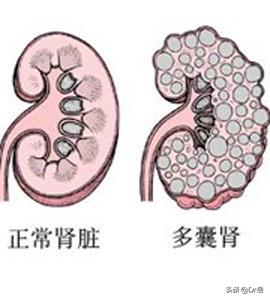 多囊肾肌酐130到尿毒症有多长时间,多囊肾肌酐179能控制多久到尿毒症