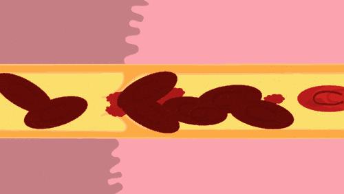 动脉斑块多长时间可以逆转消失,心脏动脉斑块可以消除吗