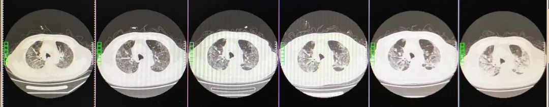 核酸检测阴性抗体阳性怎么回事,一确诊病例17次核酸检测阴性