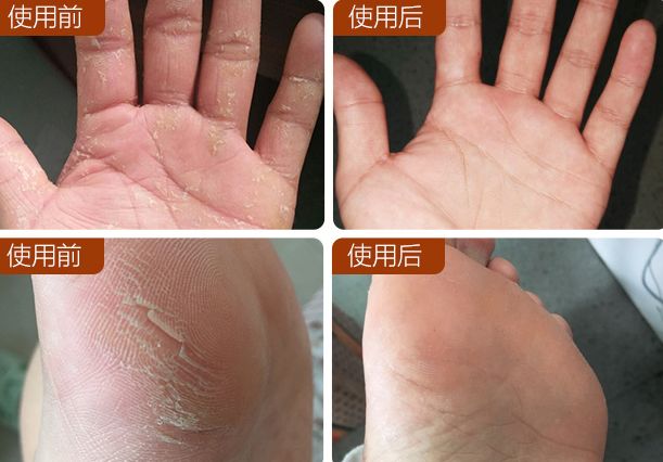 手脚皮肤干裂怎样快速保湿,缓解手脚干裂的小妙招