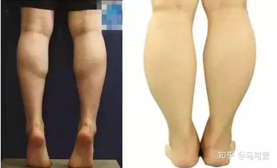 萝卜腿瘦小腿最快方法,一招告别小粗腿