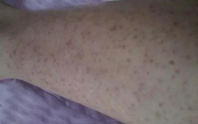 鸡皮肤严重的人图片,很严重的鸡皮肤能治好吗