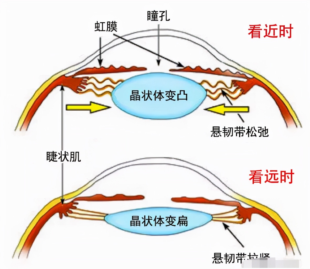 如何判断眼睛是否近视散瞳验光,如何判断散瞳后真假近视