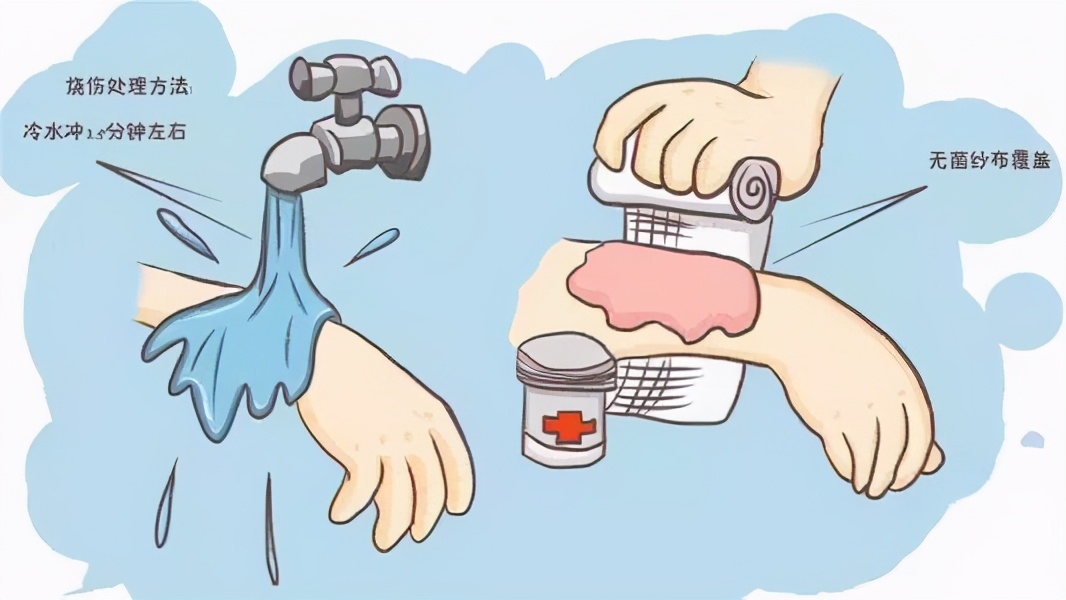 5岁男童跌入汤桶严重烫伤,幼儿园孩子烫伤怎么正确处理