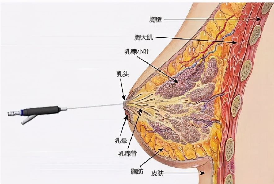 乳头溢液4年会得乳腺癌吗,乳头溢液可能是乳腺癌吗