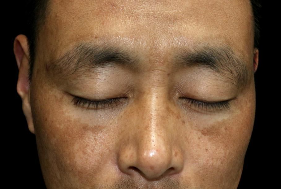 褐青斑与黄褐斑鉴别,面色容易出现褐斑