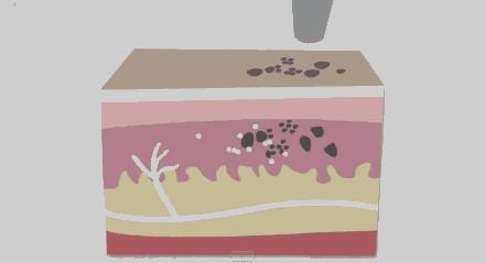 纹身激光去除后可以参军吗,激光去除纹身疤痕可以当兵吗