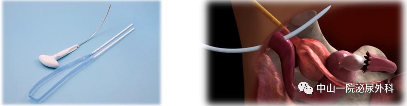 中山一院梁月有教授简介,压力性尿失禁中医能治好吗