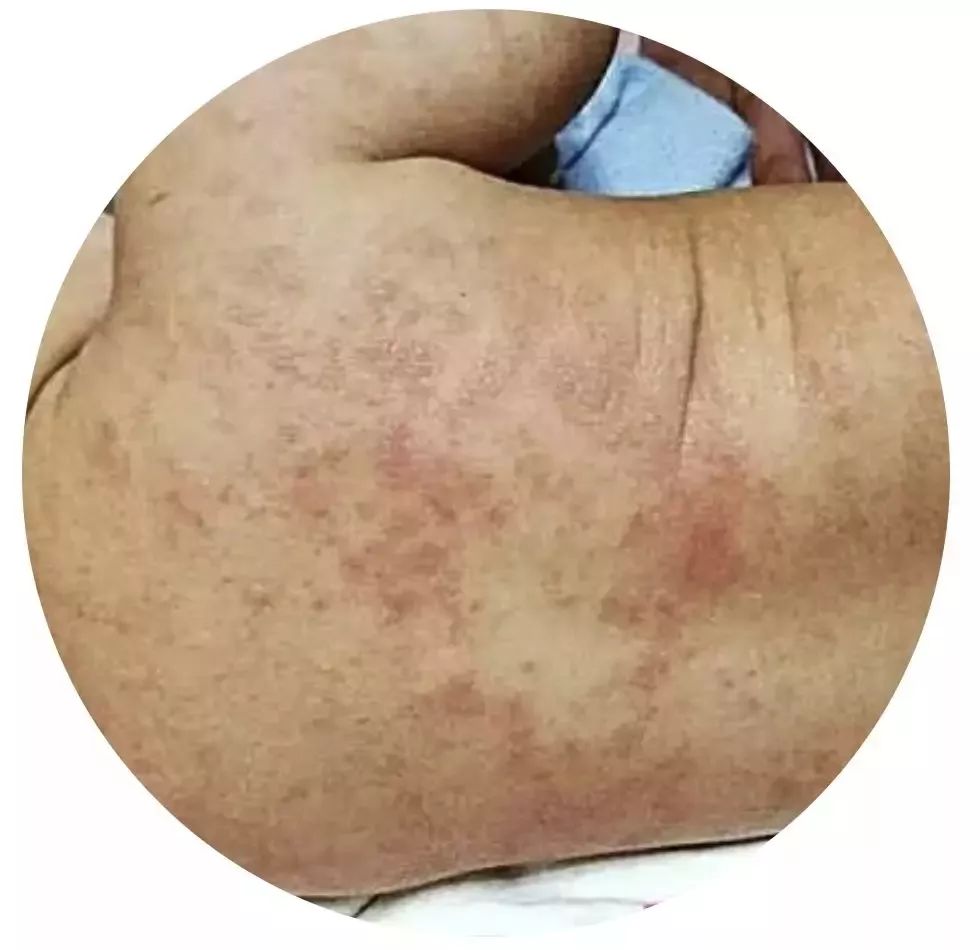 夏天宝宝长痱子有什么好办法吗,夏天宝宝长痱子怎么办