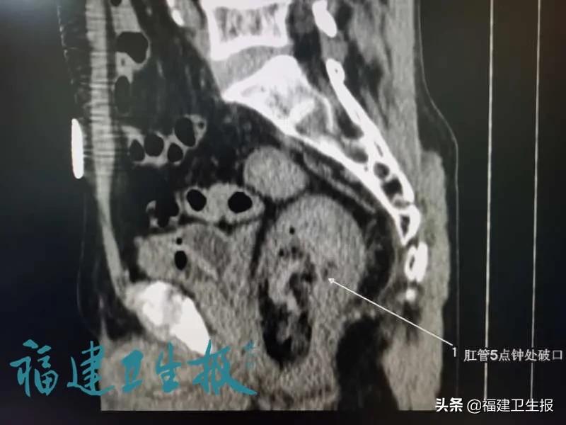 便秘小伙用塑料管通便致肠穿孔,便秘多年未治愈8旬大爷拿刀插腹