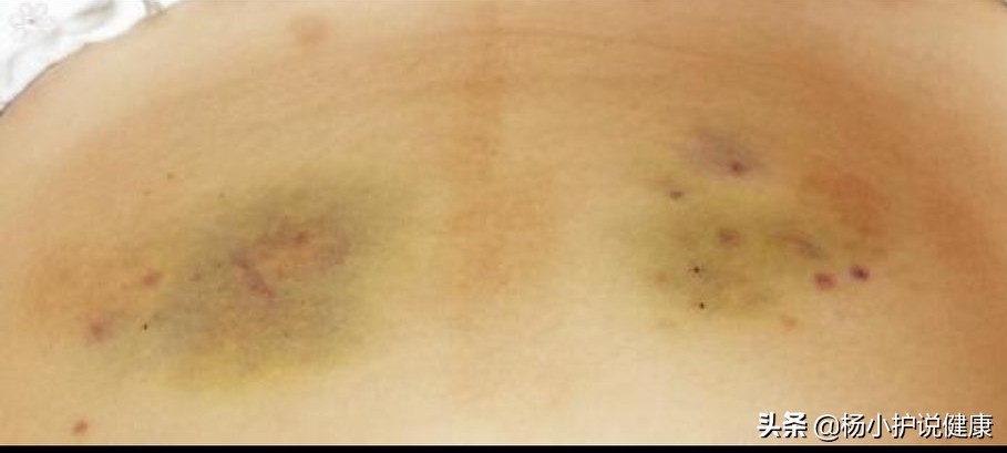 肚皮针应该怎么打,皮肤才没有淤癍?