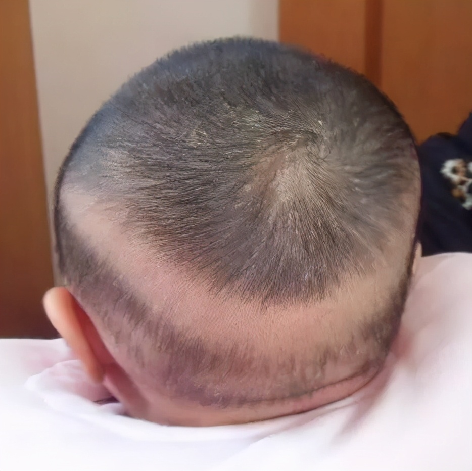 婴幼儿脱发是什么原因引起的,宝宝也会脱发吗