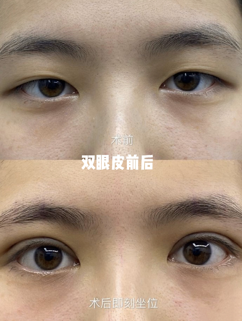 眼角开的形状不自然能修复么,眼角开大了恢复后会变小吗