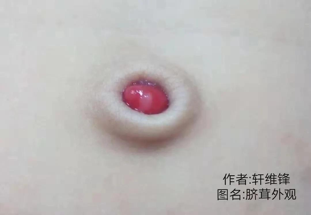 脐部护理的介绍,新生儿脐部护理