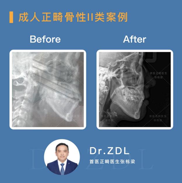 骨性龅牙和牙性龅牙的区别,牙性龅牙和骨性龅牙怎么矫正