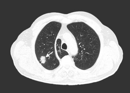 抗击新冠病毒肺炎,新冠病毒感染如何避免造成肺炎