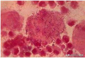 什么是子宫颈癌？它有哪些临床表现？中医是怎样认为的？