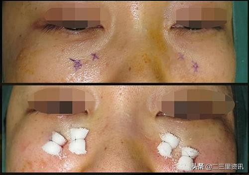 悔！沈阳女子街边小店除眼袋险致盲住院就医才复明