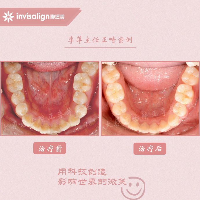 龅牙矫正牙齿能解决下颌后缩么,儿童正畸能解决鼻基底凹陷问题吗