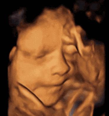 四维检查是好的但生下宝宝脚内翻,四维彩超通过后胎儿还会畸形吗