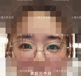 眶隔释放去眼袋为何如此受青睐？原因原来不仅仅是这样