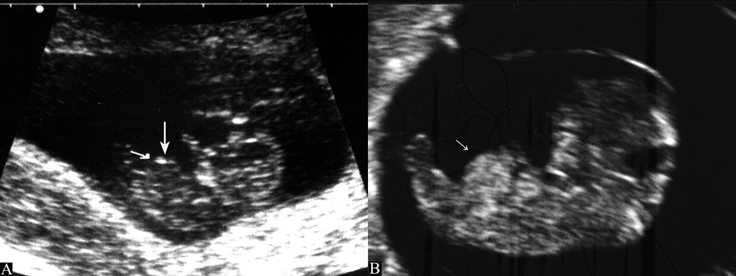 做四维彩超时胎儿动态视频,孕早期超声怎么诊断胚胎发育不良