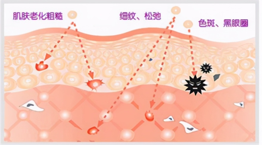 医美能从光子嫩肤开始,医美光子嫩肤是干啥的