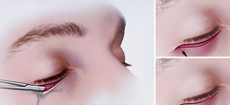 什么是无痕祛眼袋手术,紫洁祛眼袋手术失败案例