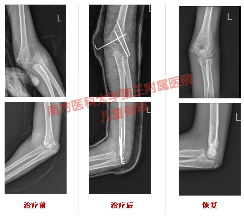 小孩胳膊骨折的治疗方法,胳膊骨折后骨折处发热怎么回事