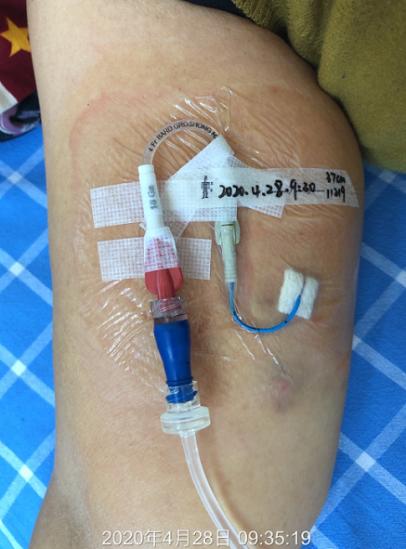 留置picc需要什么医嘱,picc静脉置管能随时拔除