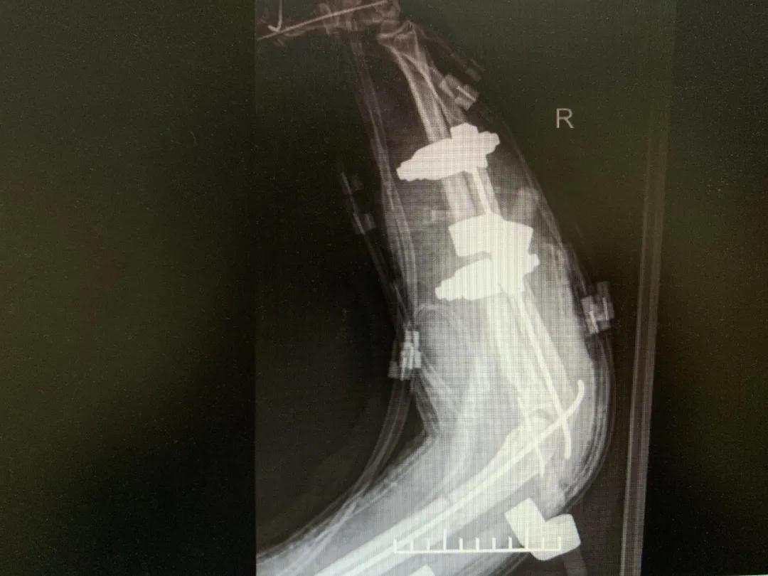 【日照市人民医院】右臂卷入机器被撕裂　6.5小时成功复活