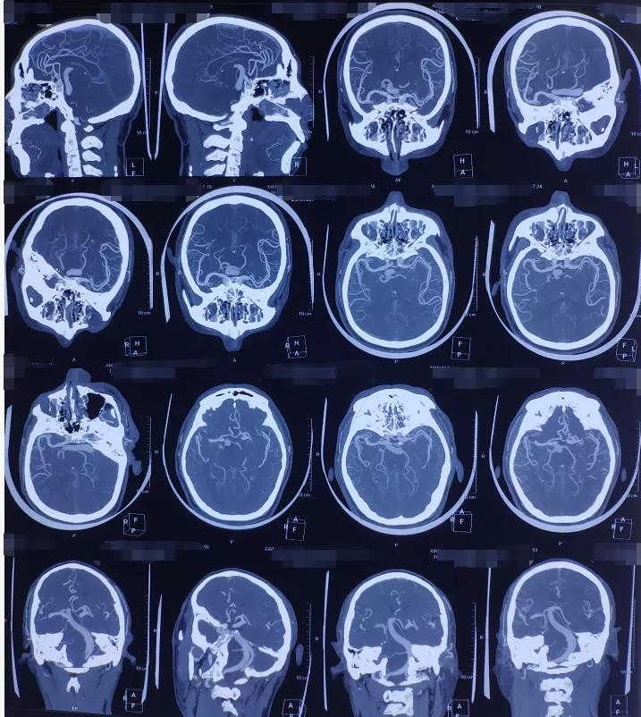 面肌痉挛球囊压迫和微血管减压术,微血管减压术治疗三叉神经痛