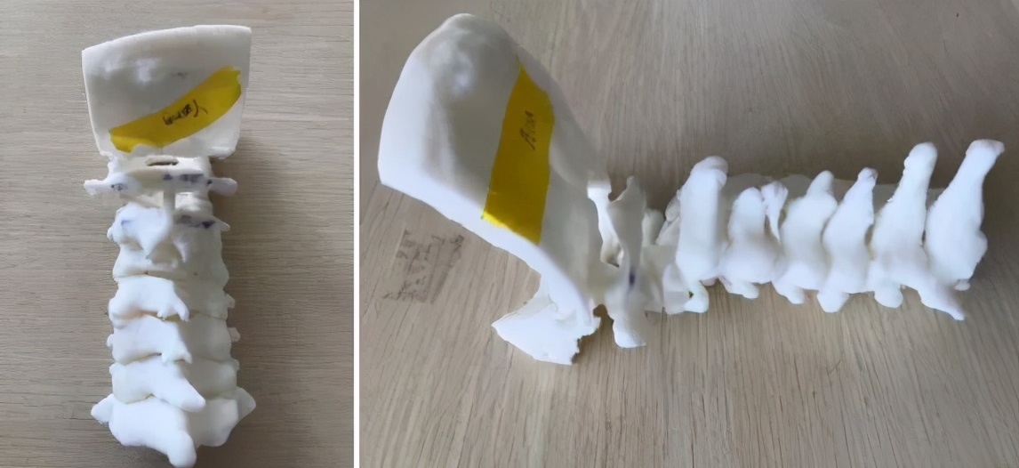 颈椎粉碎性骨折,颈椎粉碎性骨折后期康复