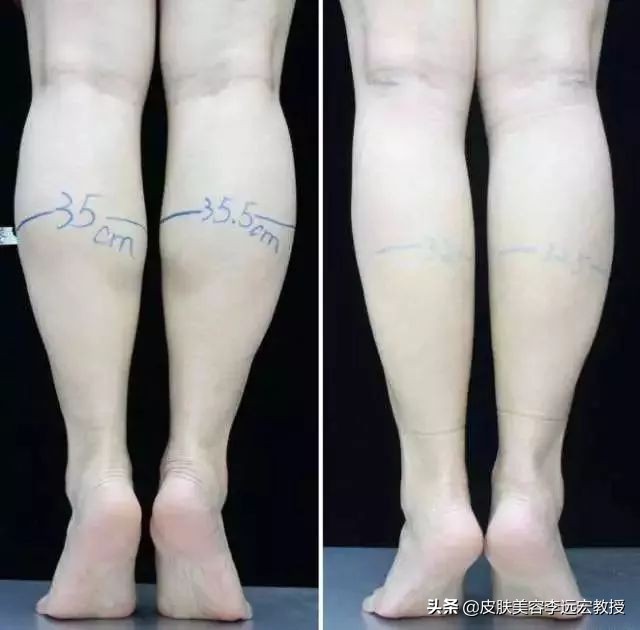 大腿粗小腿细怎么拯救,大腿小腿粗怎么减才有效