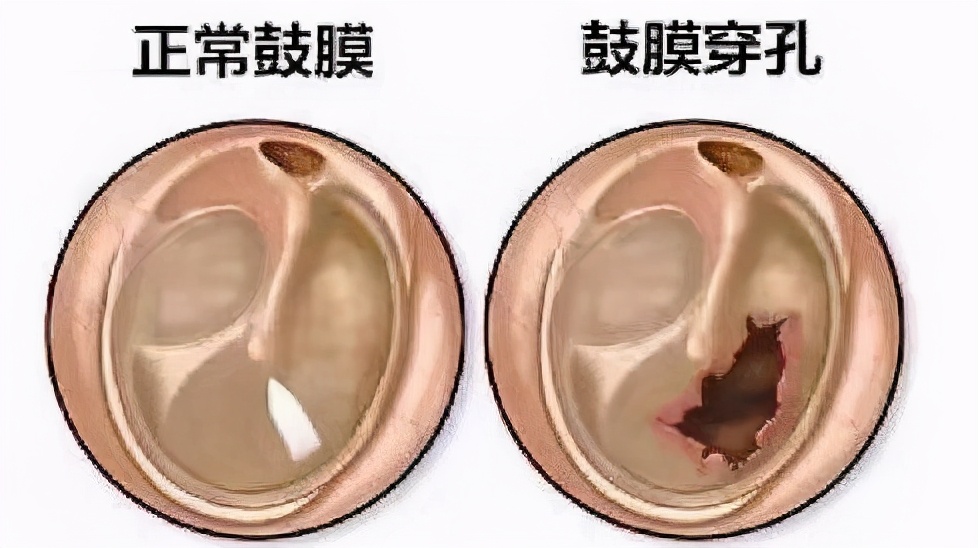 打蚊子致鼓膜穿孔,睡觉拍蚊子属于简单反射吗