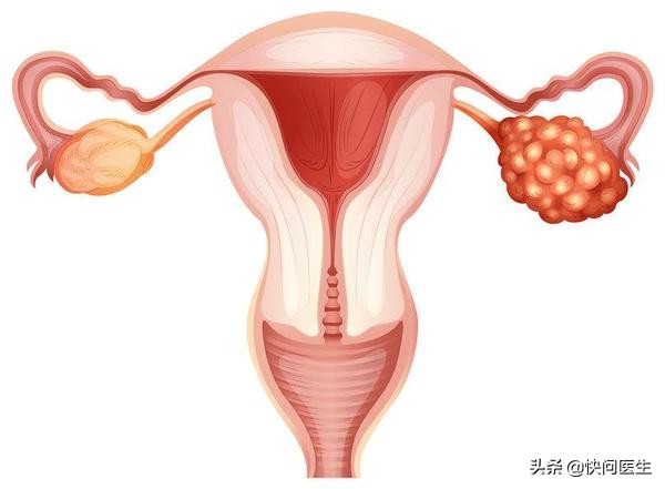 没结婚会有卵巢囊肿和盆腔粘连吗,未婚女性卵巢囊肿的症状和并发症