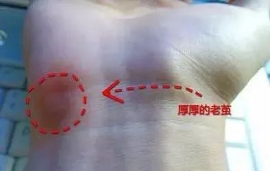 鼠标手疼痛如何缓解,手麻手抖手僵硬怎么办