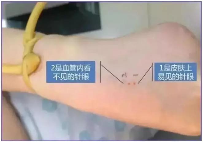 小孩输液管里有虫状物,孩子输液管有虫子后续