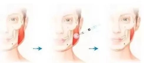瘦脸针过量脸下垂怎么办,经常打瘦脸针是不是脸更容易下垂