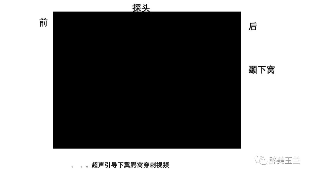 病例分享丨三叉神经节微球囊压迫术的麻醉管理