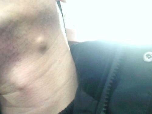 预防粉瘤,脂肪瘤怎样预防及治疗