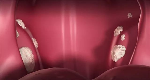 种草鸡丨惊呆了！30秒漱出扁桃体结石！