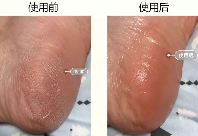 手脚冻疮怎么治断根,冬季治手脚干裂冻疮有效的药
