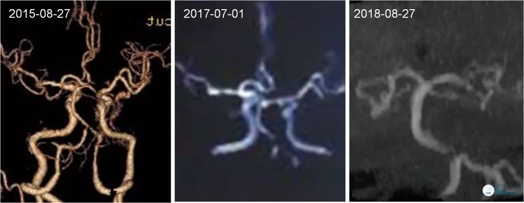 椎动脉狭窄介入手术病例汇报,基底动脉狭窄70%的介入治疗