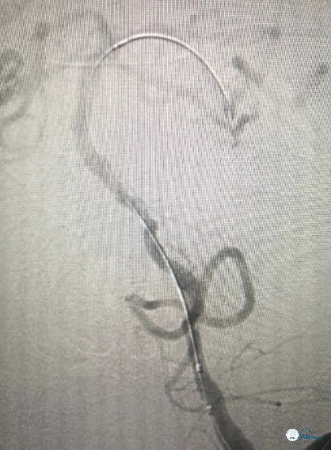 椎动脉狭窄介入手术病例汇报,基底动脉狭窄70%的介入治疗