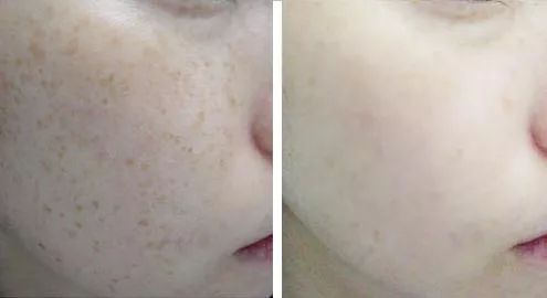 如何改善色斑暗沉问题,面色暗沉色斑多如何改善